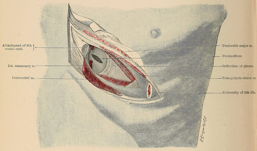 Surgical illustration showing layers of incision to chest between ribs