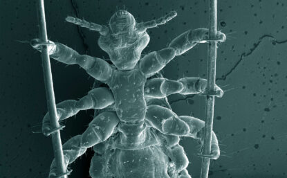 head louse holding hair strands