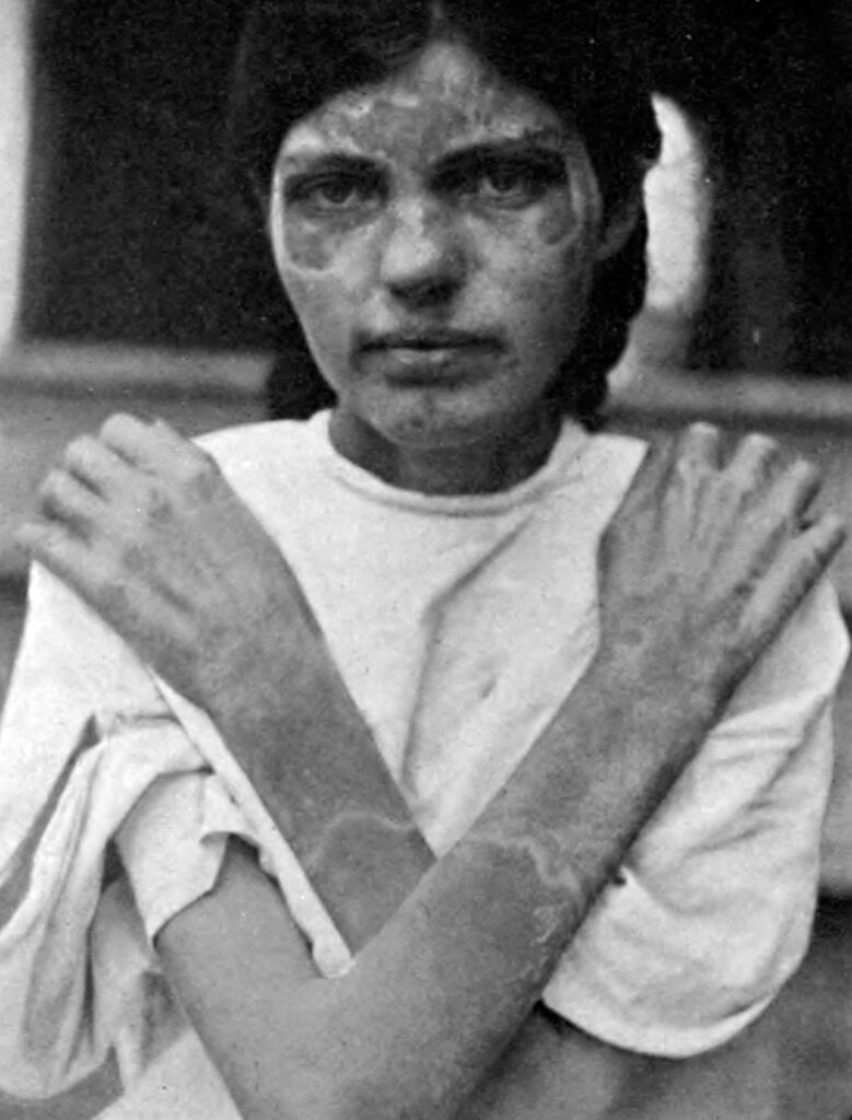 Black and white photo of young woman with lesions on face and hands