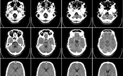 Black and white grid of brain scans. Computer tomography of human brain, from base of the skull to top.